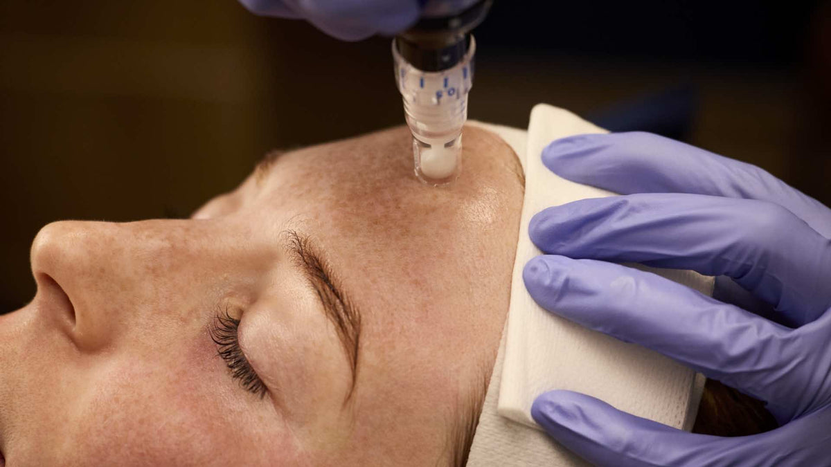 SkinPen Microneedling