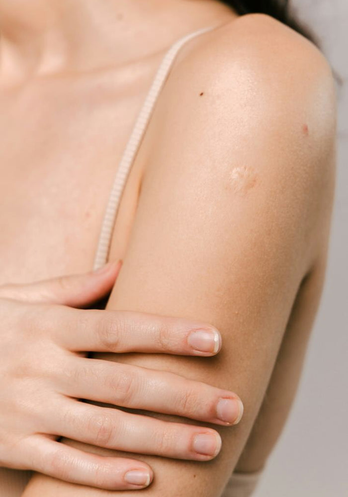 Scarring (Acne or Injury)