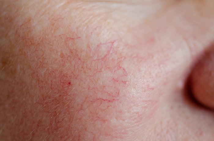 Facial Capillaries & Veins
