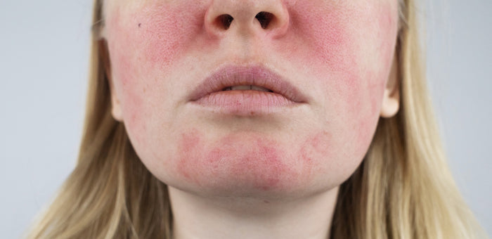Rosacea & Redness