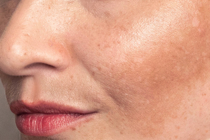 Pigmentation & Sun Damage